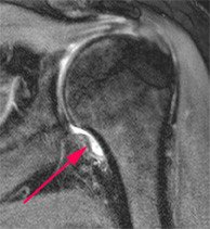 MRI Frozen Shoulder