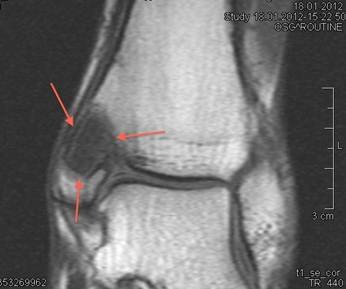 MRI Zyste