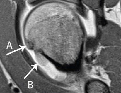 MRI Gutartiger Knochentumar an der Hüfte