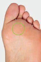 Hallux Valgus Hornhautbildung am Vorfussballen