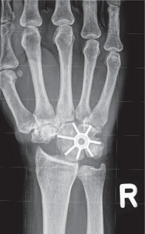 Teilversteifung Handgelenk 