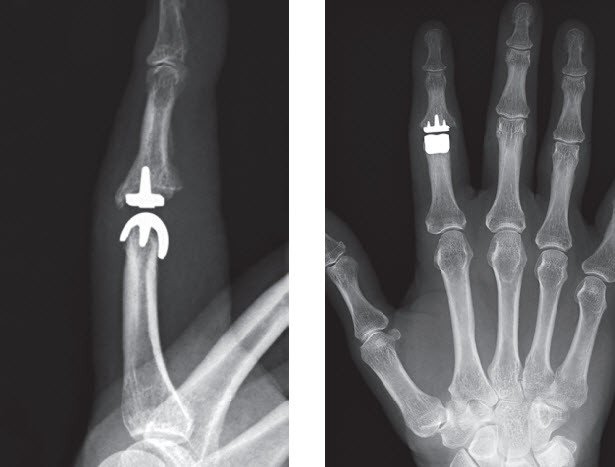 CapFlex®-Oberflächenprothese