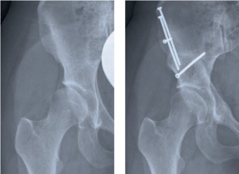 Periacetabuläre Osteotomie (PAO) zur Behandlung einer Hüftdysplasie