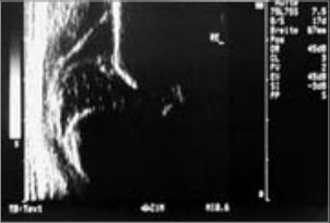Sonographiebild einer Hüftluxation