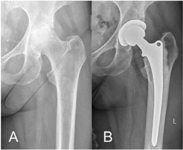 Röntgenbild kompletter Gelenkspaltverlust der linken Hüfte