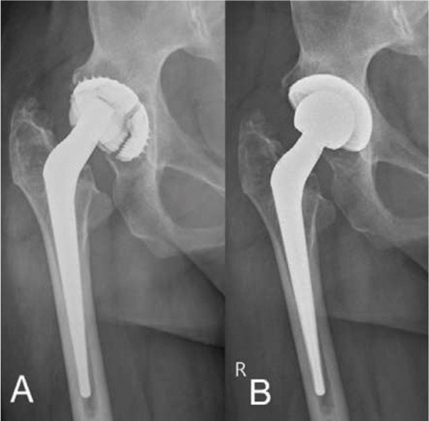 Vollkommen aufgebrauchtes Polyethylen der rechten Hüftprothese