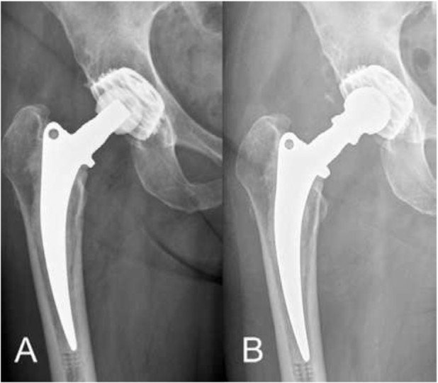 Präoperatives Röntgenbild der rechten Hüftprothese