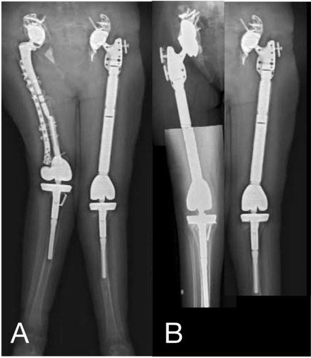 Postoperatives Röntgenbild Hüftgelenksarthrose