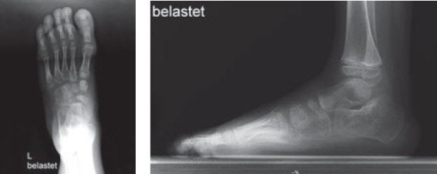 Röntgenbild auskorrigierter Fuss Klumpfuss