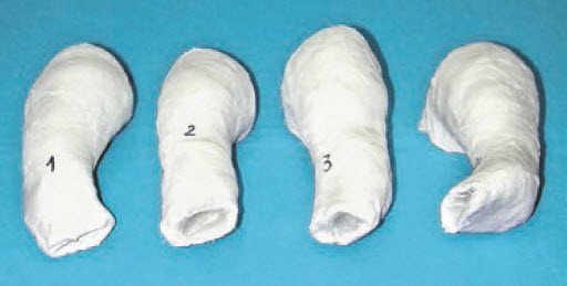 Typische Gipsserie einer Redressionsbehandlung