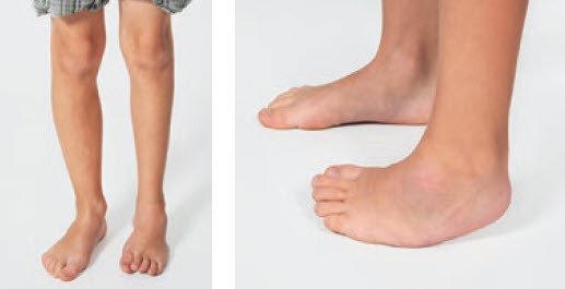 Klumpfussdeformität Kinder