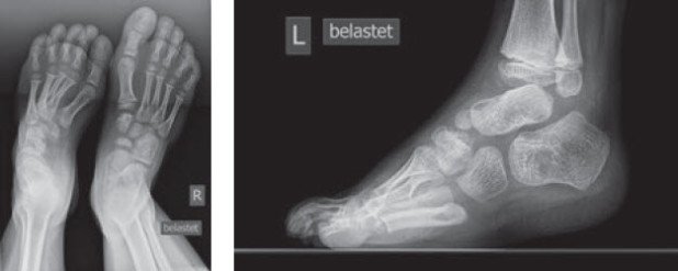Röntgenbild Flumpfuss