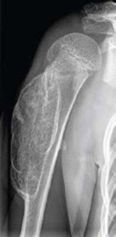 Breitbasige Exostose am proximalen Humerus