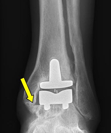 OSG Impingement nach Prothesenimplantation