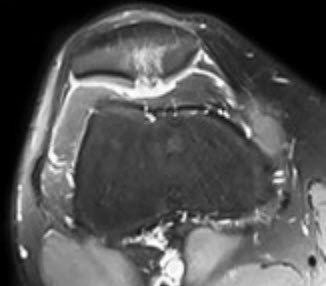 MRI Knorpelschaden im Bereich der Patellarückfläche