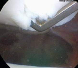 Arthroskopie Knorpelschaden