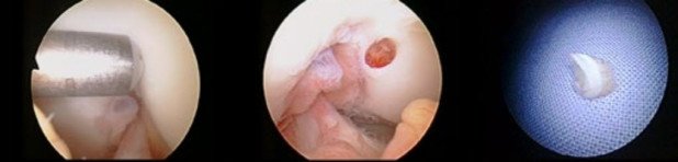 Arthroskopie Knorpelprobe