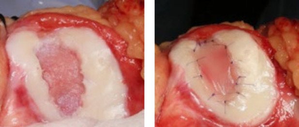 Entfernung Knorpelschaden