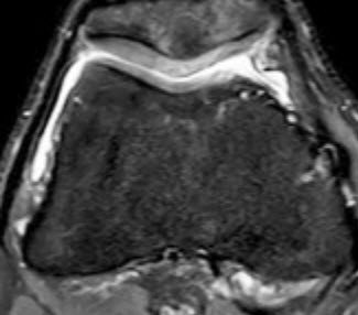 MRI Knorpelregenerat