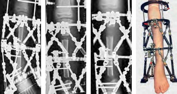 Knochenverlängerung und Achskorrektur 