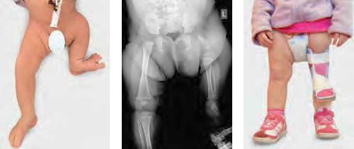 Schwere Oberschenkelfehlbildung