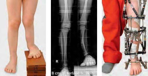 Kombinierte Fehlbildung des Ober- und Unterschenkels