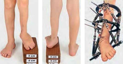 Zweite Verlängerungsetappe