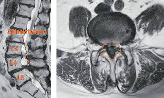 MRI Spinalstenose