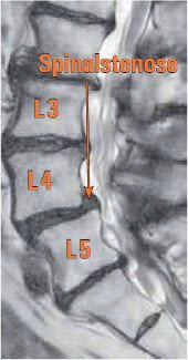 MRI LEndenwirbelsäule