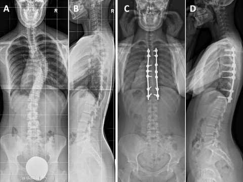 Minimal-invasive Skoliosechirurgie bei idiopathischer Skoliose