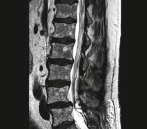 MRI der Lendenwirbelsäule bei Rückenschmerzen