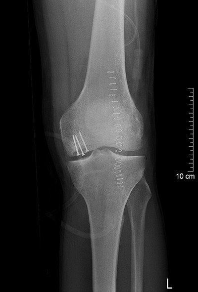 Röntgenbild Osteochondrosis dissecans