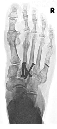 Röntgenbild Pseudoarthrose