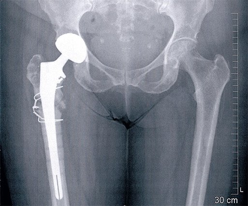 Pseudoarthrose nach Femurfraktur