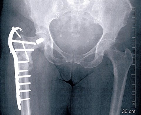 Pseudoarthrose nach Femurfraktur | Schulthess Klinik