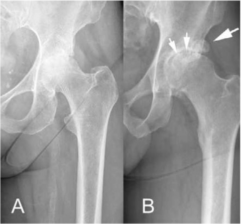 Rheumatoide Arthritis Hüfte