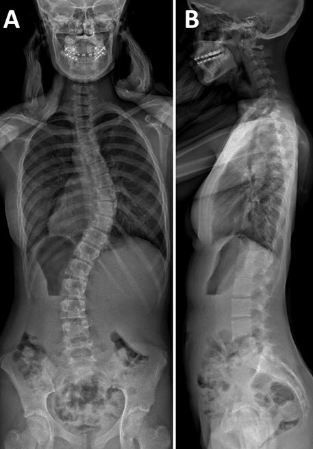 idiopathische Skoliose