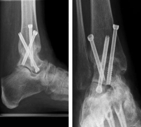 Konsolidierte Arthrodese mit Schrauben