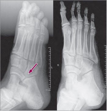 Coalitio calcaneonaviculare 