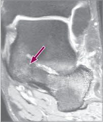 pathologische Verbindung im medialseitigen Bereich 