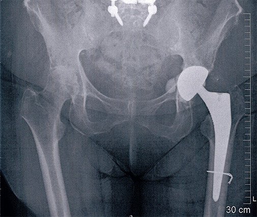 Teilabriss des Hüftmuskels bei Hüfttotalprothese