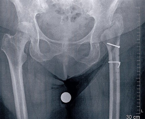 Teilabriss des Hüftmuskels bei Hüfttotalprothese