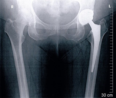 Teilabriss des Hüftmuskels bei Hüfttotalprothese
