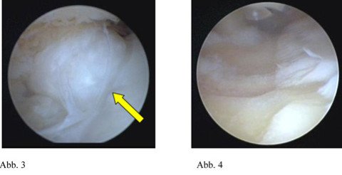 arthroskopische Entfernung Knochensporn