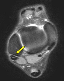 MRI Sehnenrinne