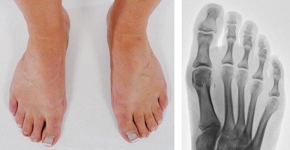 Postoperativ Sesambein