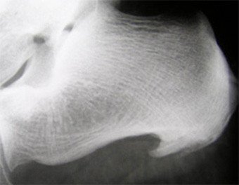 Röntgenbild Fersensporn