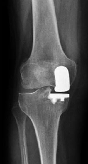 Knie-Teilprothese