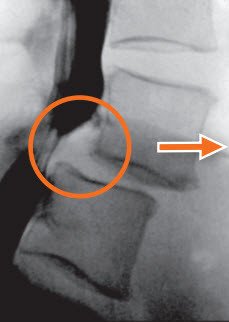 degeneratives Wirbelgleiten