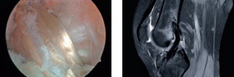 Arthroskopie und MRI einer Kreuzbandrekonstruktion